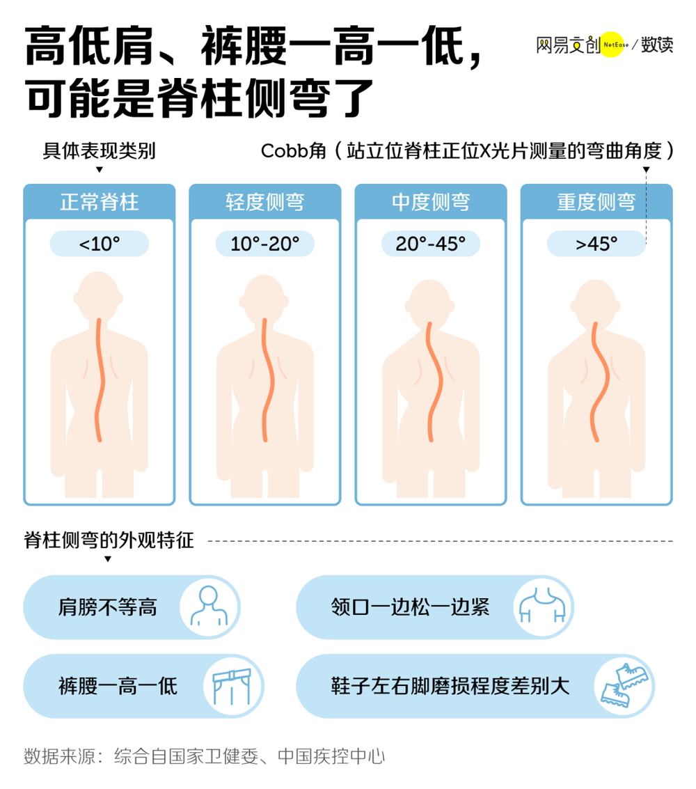 脊柱侧弯示意图
