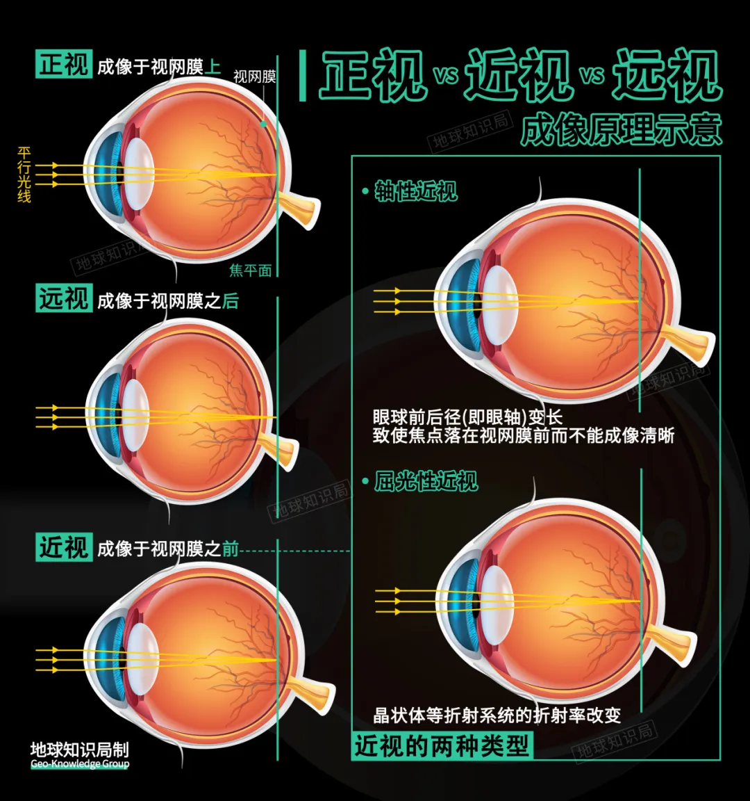 近视远视示意图