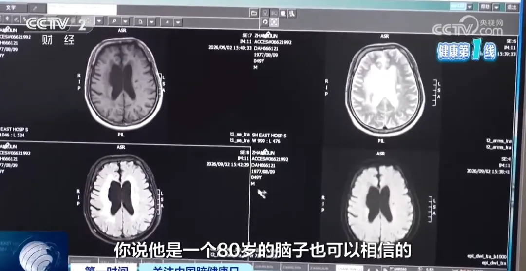 张先生脑部影像